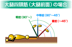 大腿四頭筋 太もも 損傷 スポーツ障害 墨田区両国のsbc湘南メディカル記念 病院