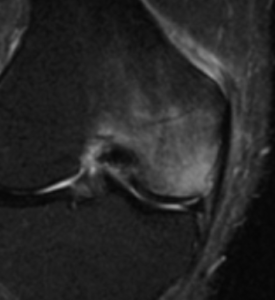 長引く骨の痛みは 骨挫傷 Bone Bruise 湘南メディカル記念病院 ドクターブログ